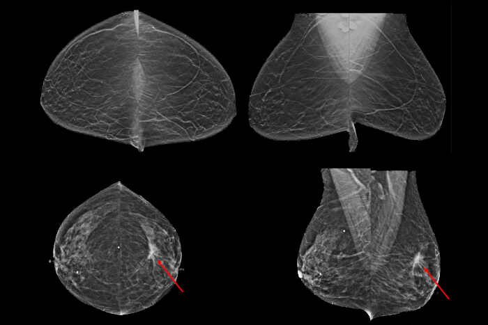 Breast imaging of a mammogram screening, with arrow detecting disease